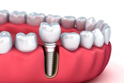 FDI project_Peri-IMplant Diseases Project